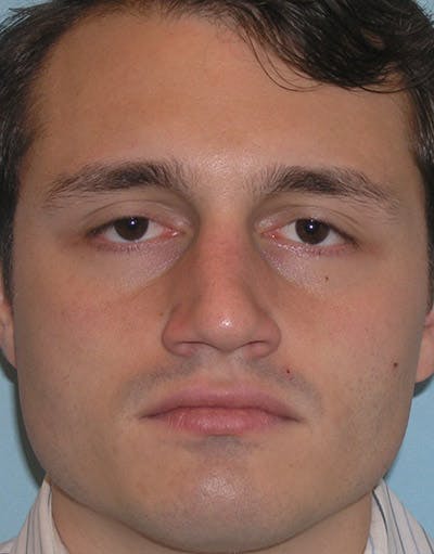 Favorite Foundation Rhinoplasty / Crooked Nose Before & After Gallery - Patient 130000 - Image 1