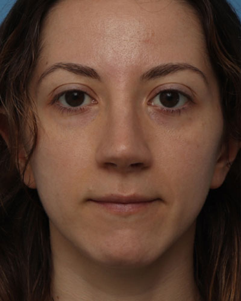 Rhinoplasty Before & After Gallery - Patient 335069 - Image 4