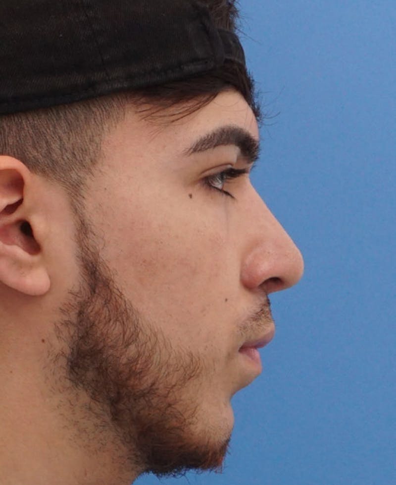Male Rhinoplasty Before & After Gallery - Patient 174465 - Image 2