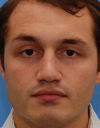 Favorite Foundation Rhinoplasty / Crooked Nose Before & After Gallery - Patient 130000 - Image 2