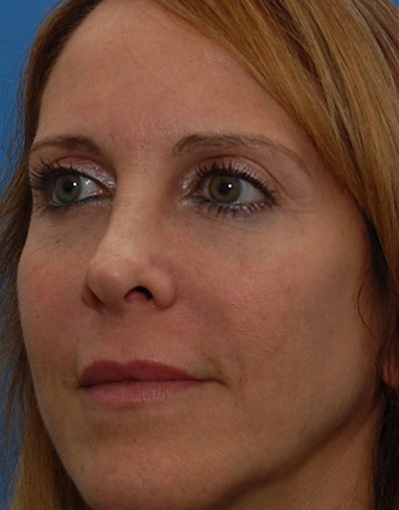 Revision Rhinoplasty Before & After Gallery - Patient 365998 - Image 8