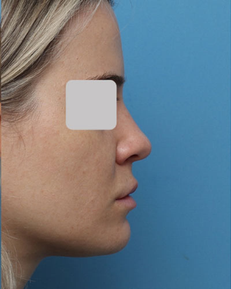 Patient PjRcYdwnQ1mFqTrhC54GCg - Rhinoplasty Before & After Photos