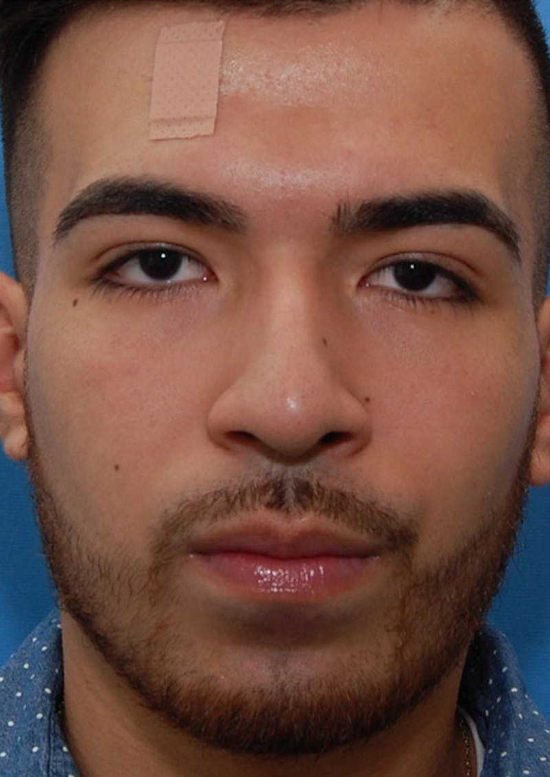 Male Rhinoplasty Before & After Gallery - Patient 174465 - Image 3