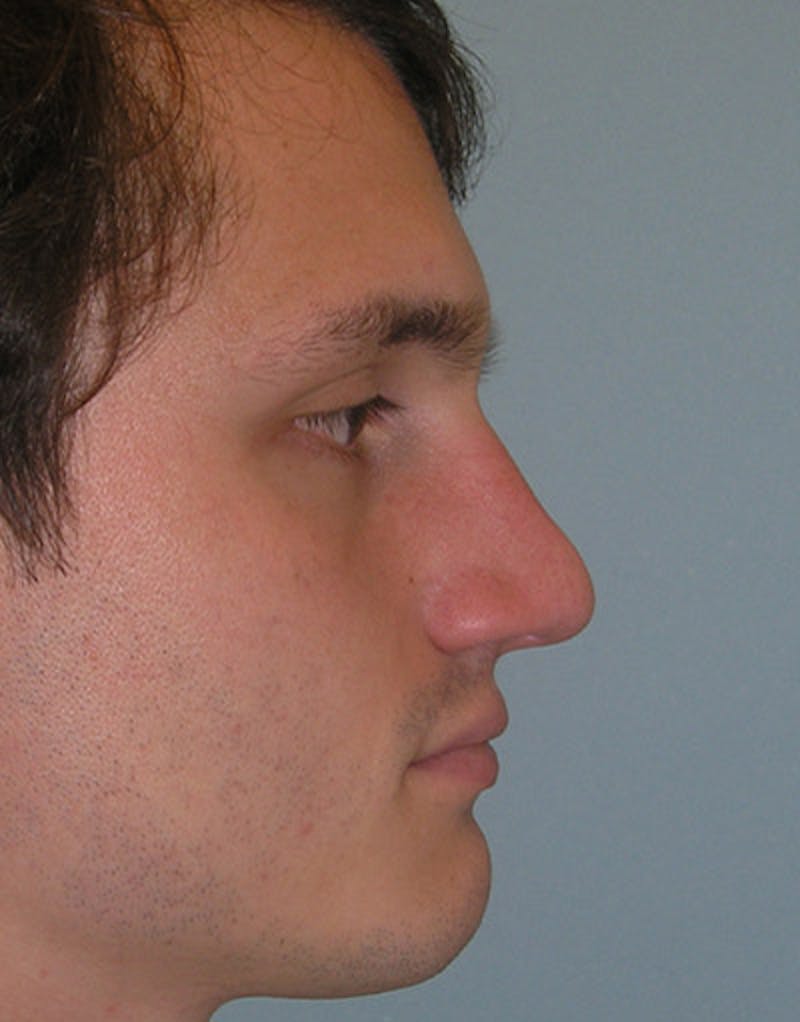 Foundation Rhinoplasty / Crooked Nose Before & After Gallery - Patient 375920 - Image 3