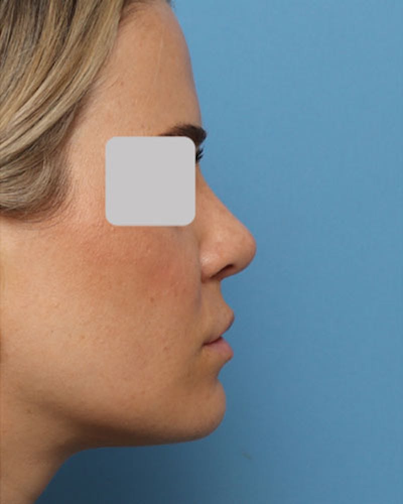 Rhinoplasty Before & After Gallery - Patient 894833 - Image 2