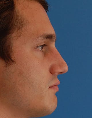 Favorite Foundation Rhinoplasty / Crooked Nose Before & After Gallery - Patient 130000 - Image 4