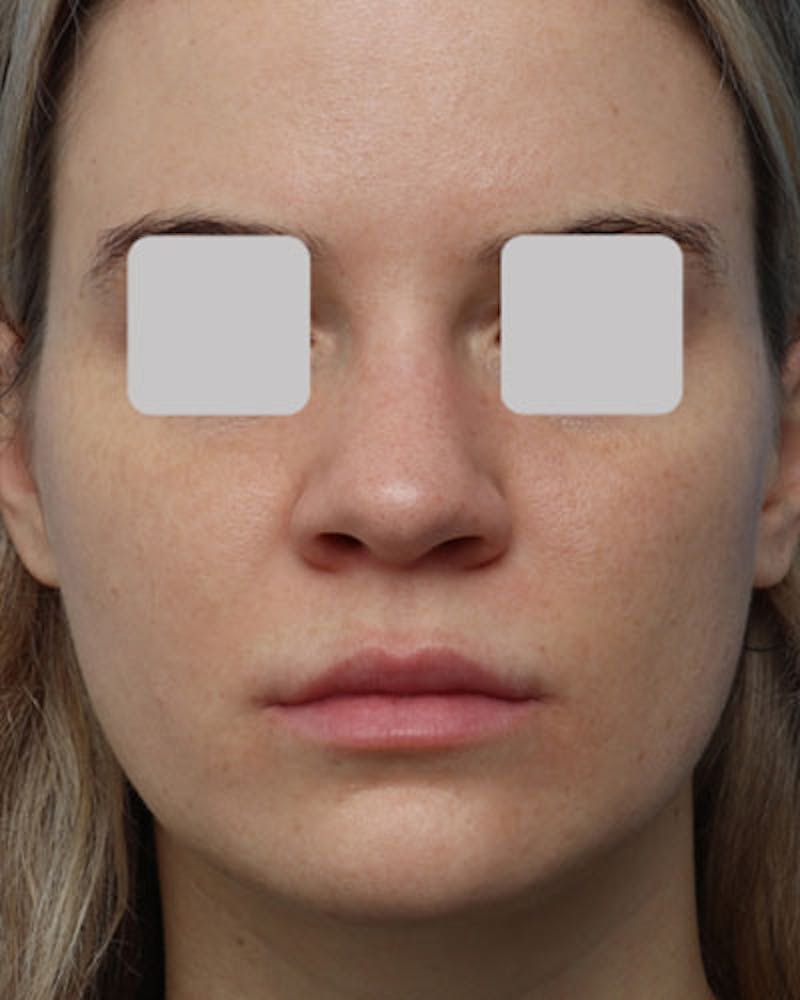 Rhinoplasty  Before & After Gallery - Patient 638048 - Image 3