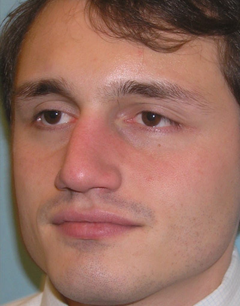 Favorite Foundation Rhinoplasty / Crooked Nose Before & After Gallery - Patient 130000 - Image 5