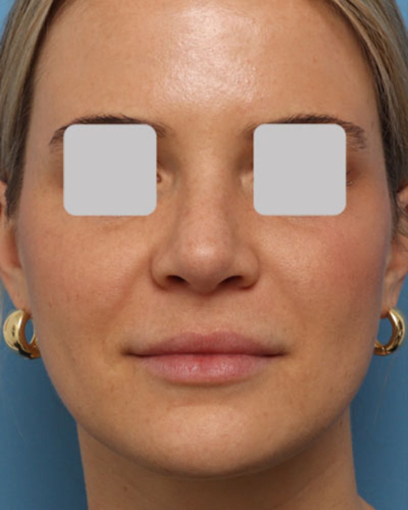 Rhinoplasty  Before & After Gallery - Patient 638048 - Image 4