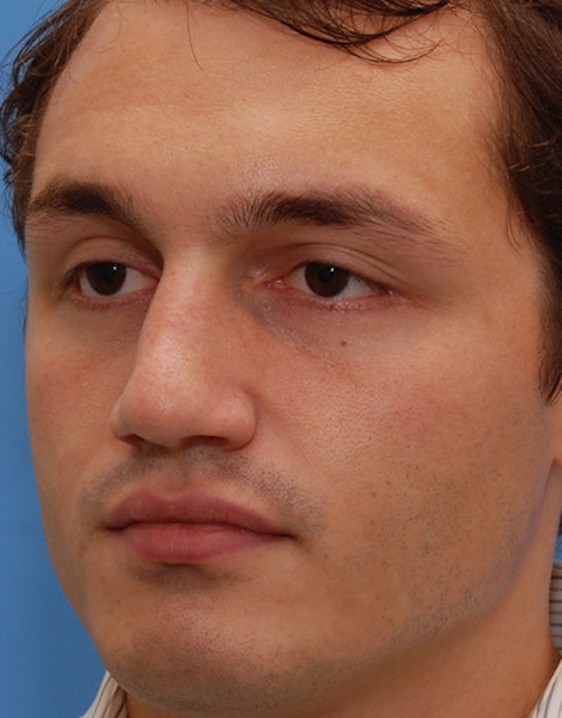 Favorite Foundation Rhinoplasty / Crooked Nose Before & After Gallery - Patient 130000 - Image 6