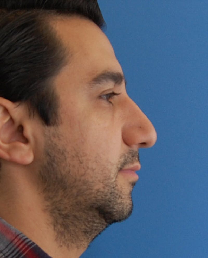 Patient RpXsDsnVS8mBGiMZ_Uz90A - Male Rhinoplasty Before & After Photos