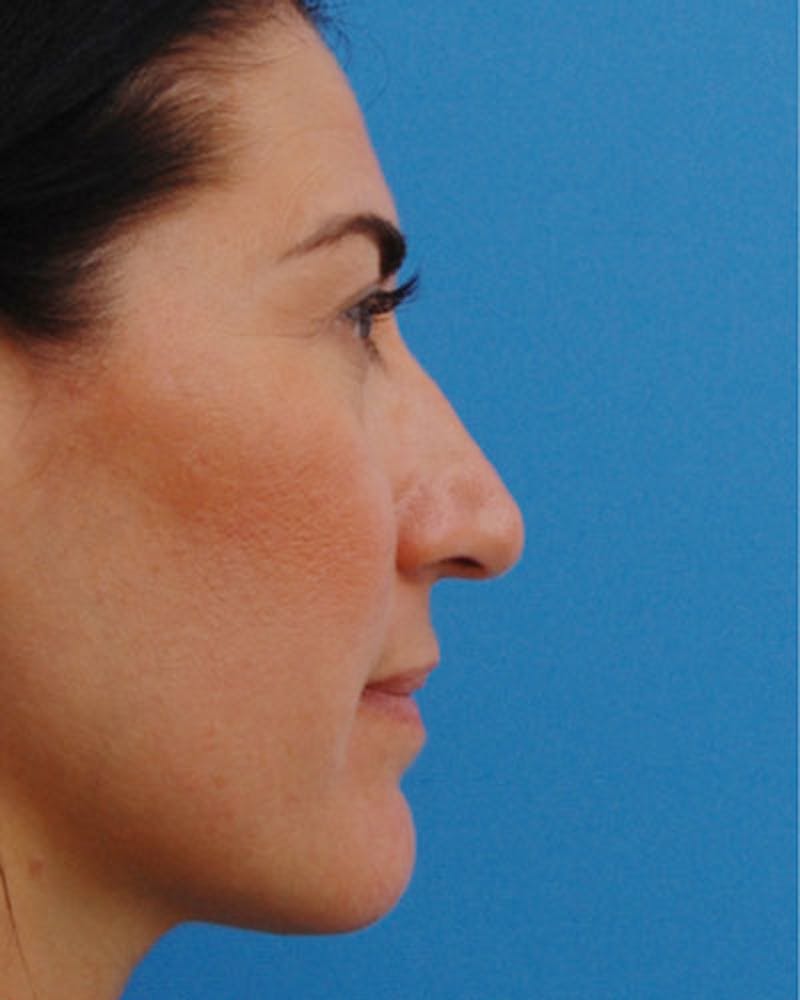 Patient JVxacJAxTQy6JMkXWSqtkw - Rhinoplasty Before & After Photos