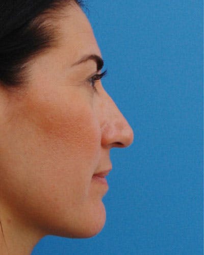 Rhinoplasty Before & After Gallery - Patient 585813 - Image 1