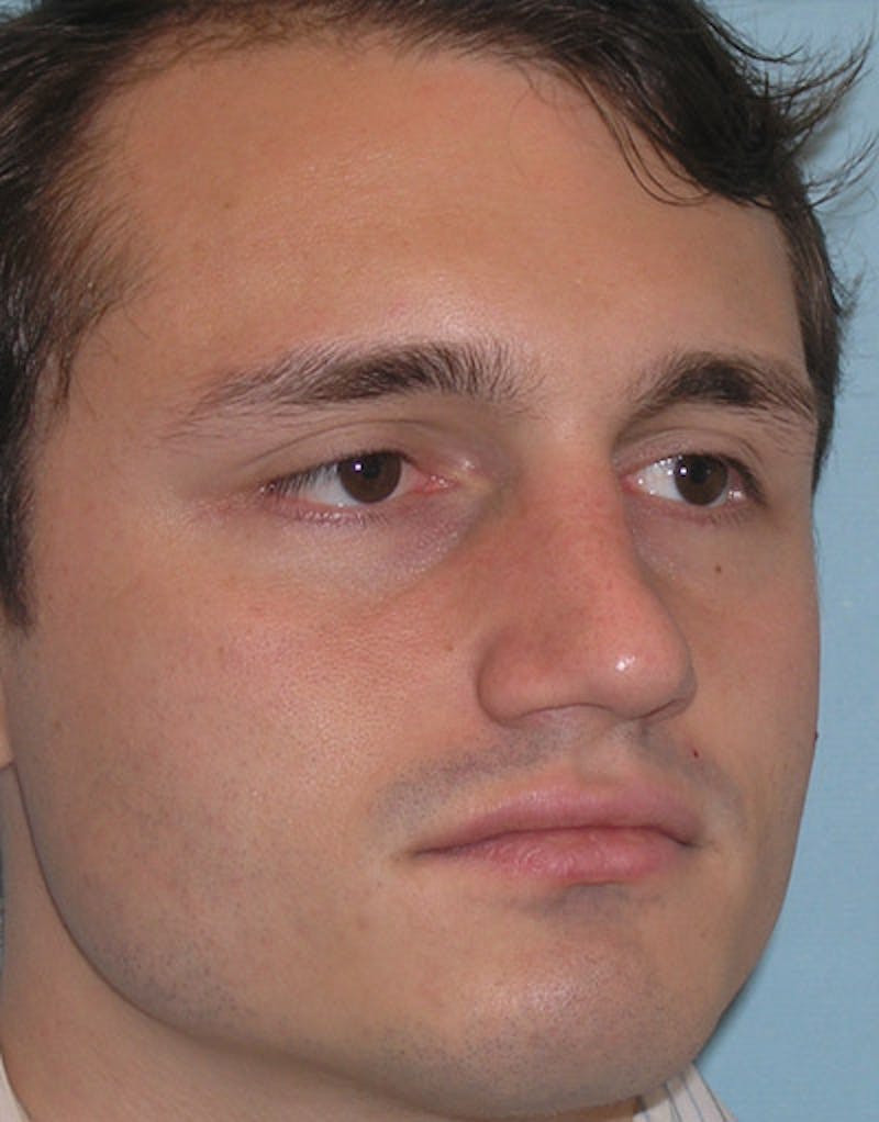 Favorite Foundation Rhinoplasty / Crooked Nose Before & After Gallery - Patient 130000 - Image 7