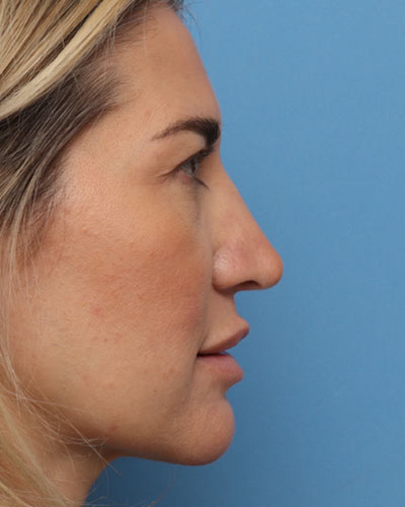 Rhinoplasty Before & After Gallery - Patient 200574 - Image 2
