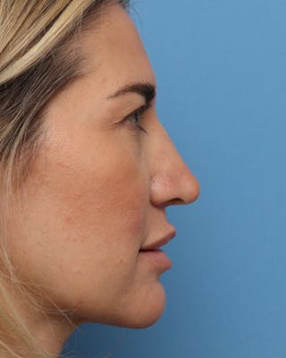 Rhinoplasty Before & After Gallery - Patient 585813 - Image 2