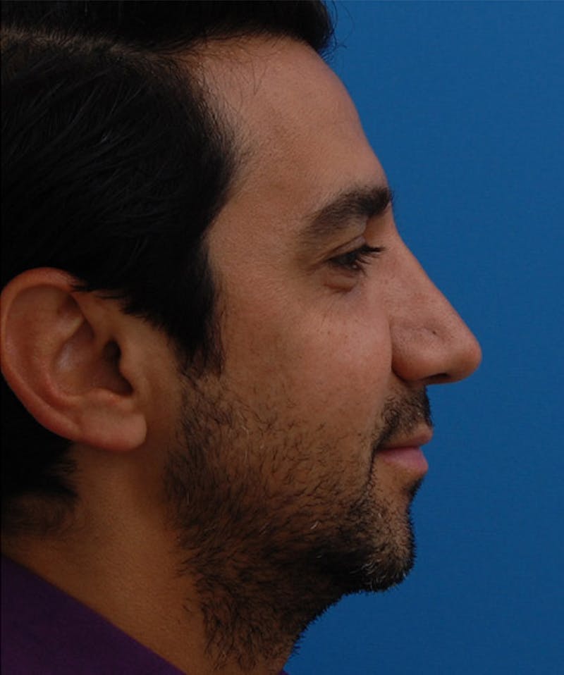 Male Rhinoplasty Before & After Gallery - Patient 301641 - Image 2