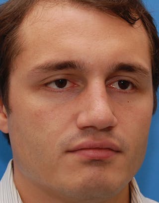 Favorite Foundation Rhinoplasty / Crooked Nose Before & After Gallery - Patient 130000 - Image 8