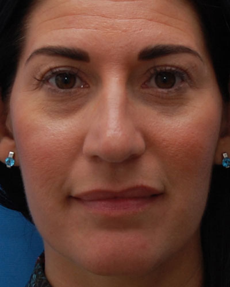 Rhinoplasty  Before & After Gallery - Patient 585813 - Image 3