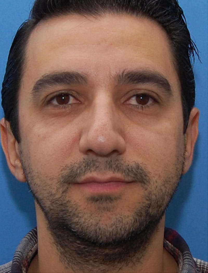 Rhinoplasty  Before & After Gallery - Patient 369597 - Image 3