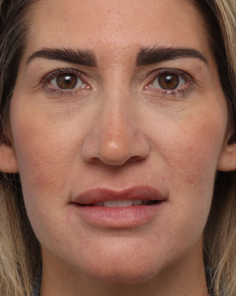Rhinoplasty  Before & After Gallery - Patient 585813 - Image 4
