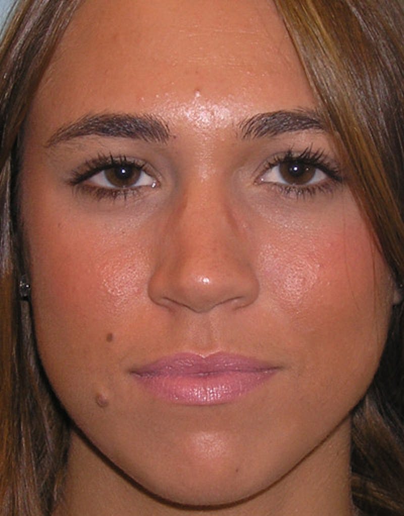 Foundation Rhinoplasty / Crooked Nose Before & After Gallery - Patient 278786 - Image 1