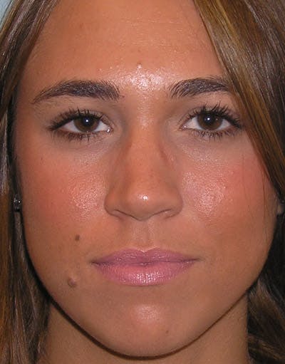 Favorite Foundation Rhinoplasty / Crooked Nose Before & After Gallery - Patient 173799 - Image 1