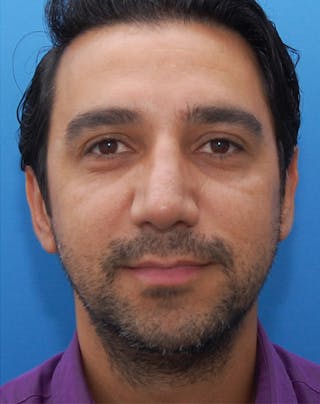 Rhinoplasty Before & After Gallery - Patient 369597 - Image 4