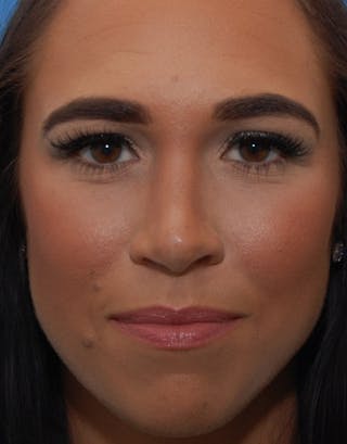 Favorite Foundation Rhinoplasty / Crooked Nose Before & After Gallery - Patient 173799 - Image 2