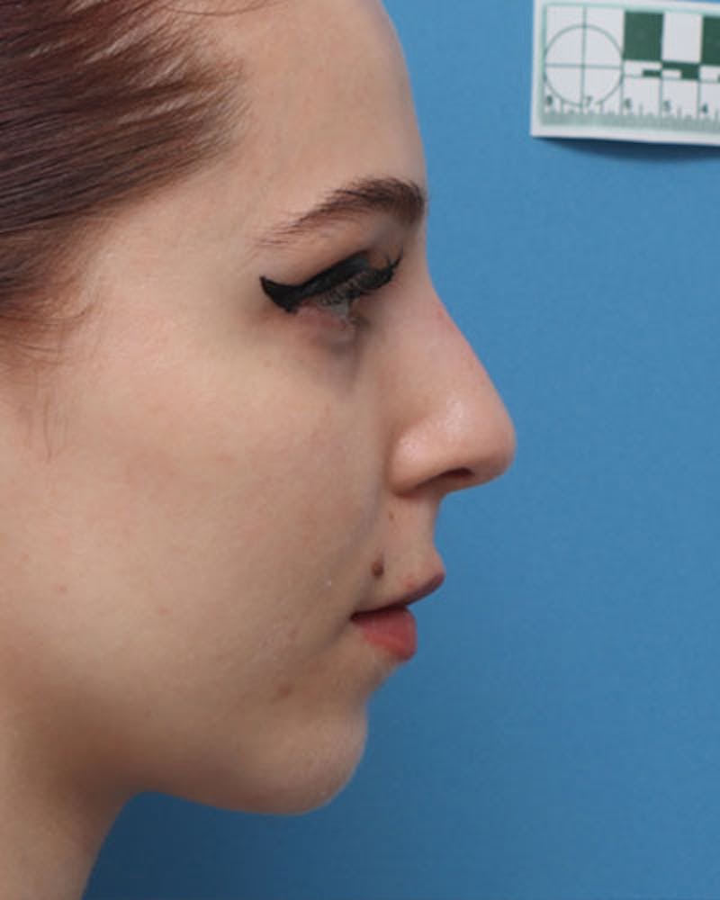 Rhinoplasty Before & After Gallery - Patient 258728 - Image 1