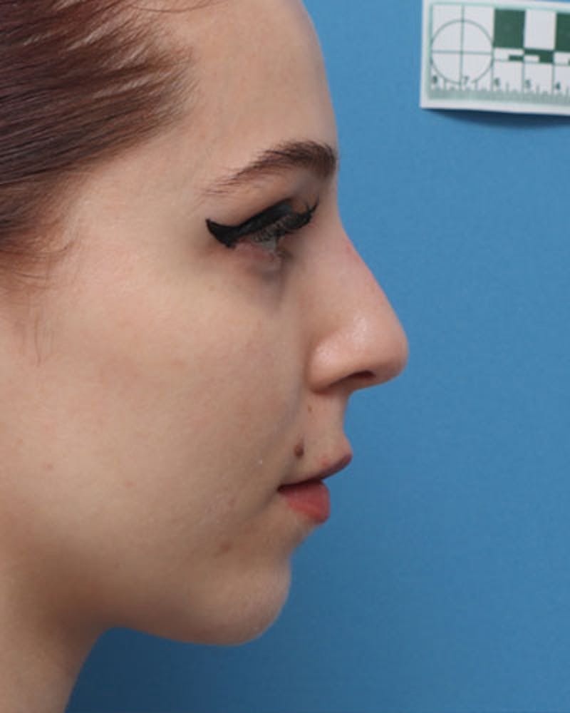 Patient PZJC2xcFTH2IPYG3JQIzRQ - Rhinoplasty Before & After Photos