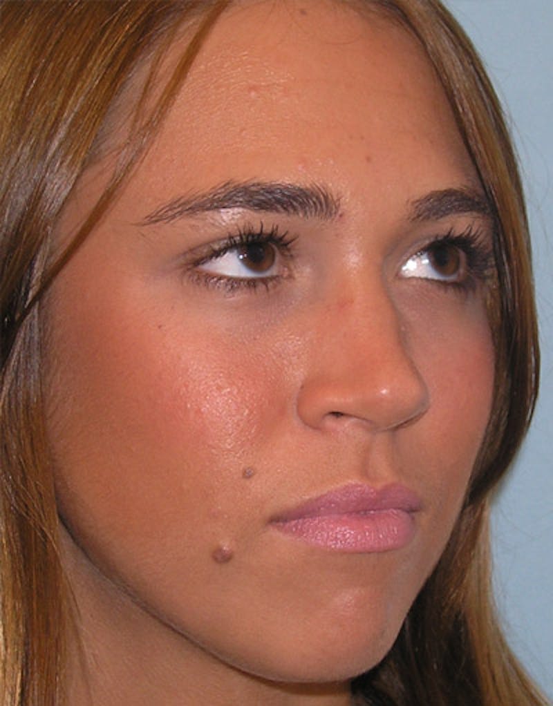Foundation Rhinoplasty / Crooked Nose Before & After Gallery - Patient 278786 - Image 3
