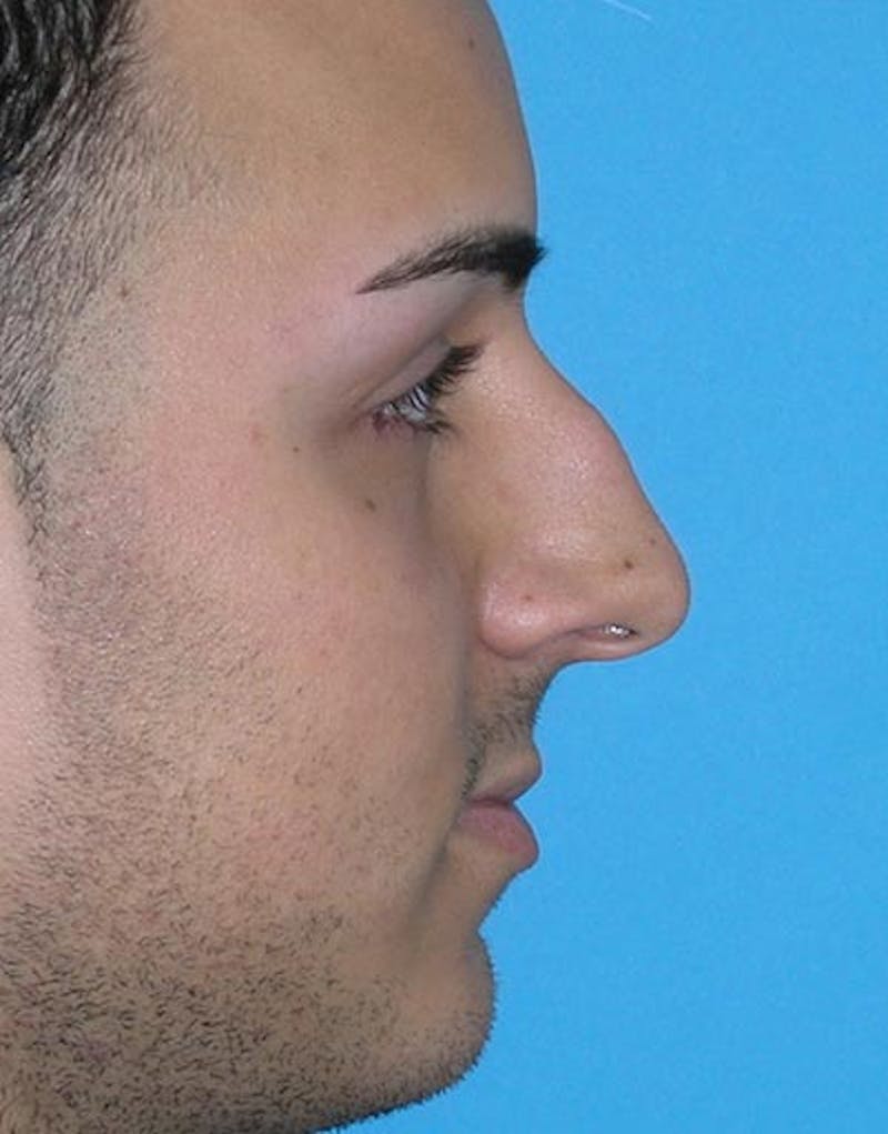Patient MbEUt4DxTvqux-vpb5m9uw - Male Rhinoplasty Before & After Photos