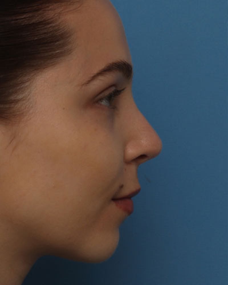 Rhinoplasty Before & After Gallery - Patient 258728 - Image 2