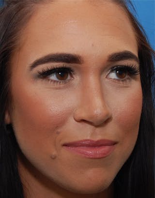 Favorite Foundation Rhinoplasty / Crooked Nose Before & After Gallery - Patient 173799 - Image 4