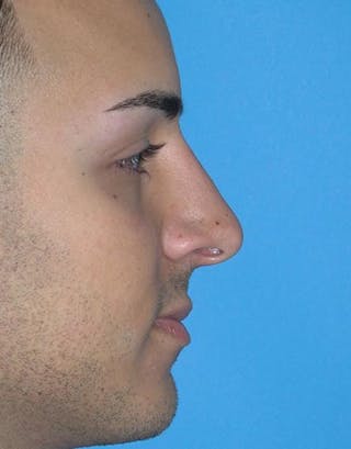 Favorite Male Rhinoplasty Before & After Gallery - Patient 338840 - Image 2