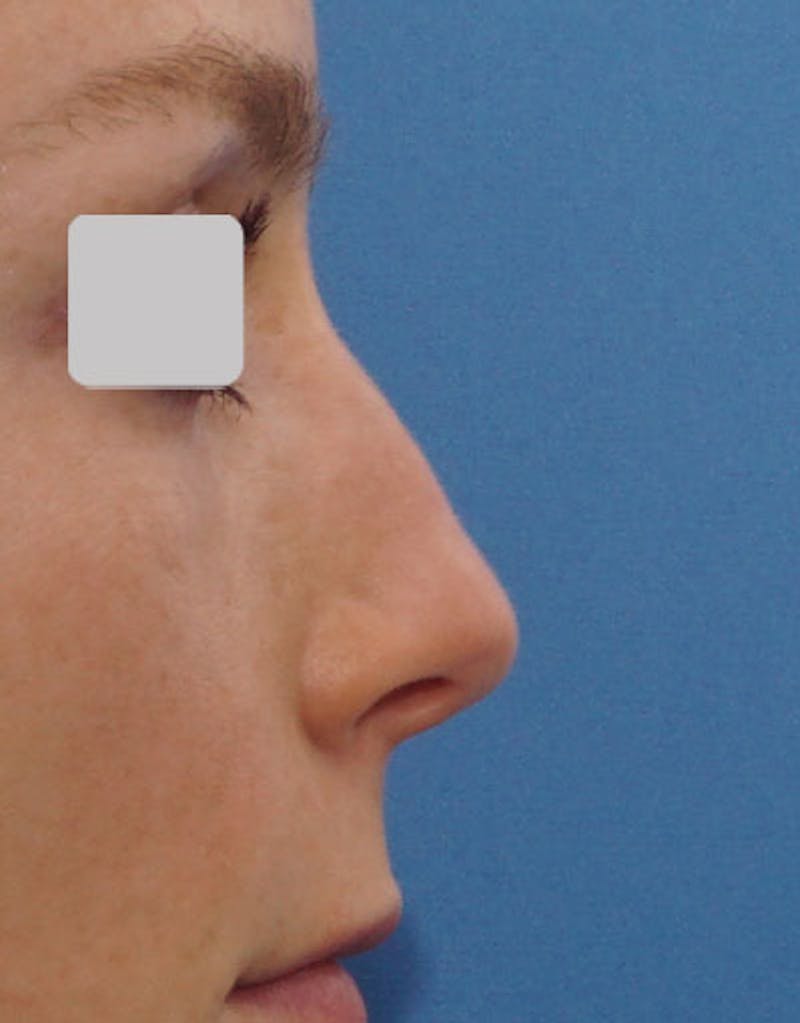 Revision Rhinoplasty Before & After Gallery - Patient 273927 - Image 1