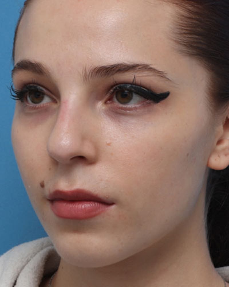 Rhinoplasty Before & After Gallery - Patient 258728 - Image 3