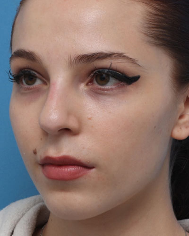 Favorite Rhinoplasty Before & After Gallery - Patient 219633 - Image 3