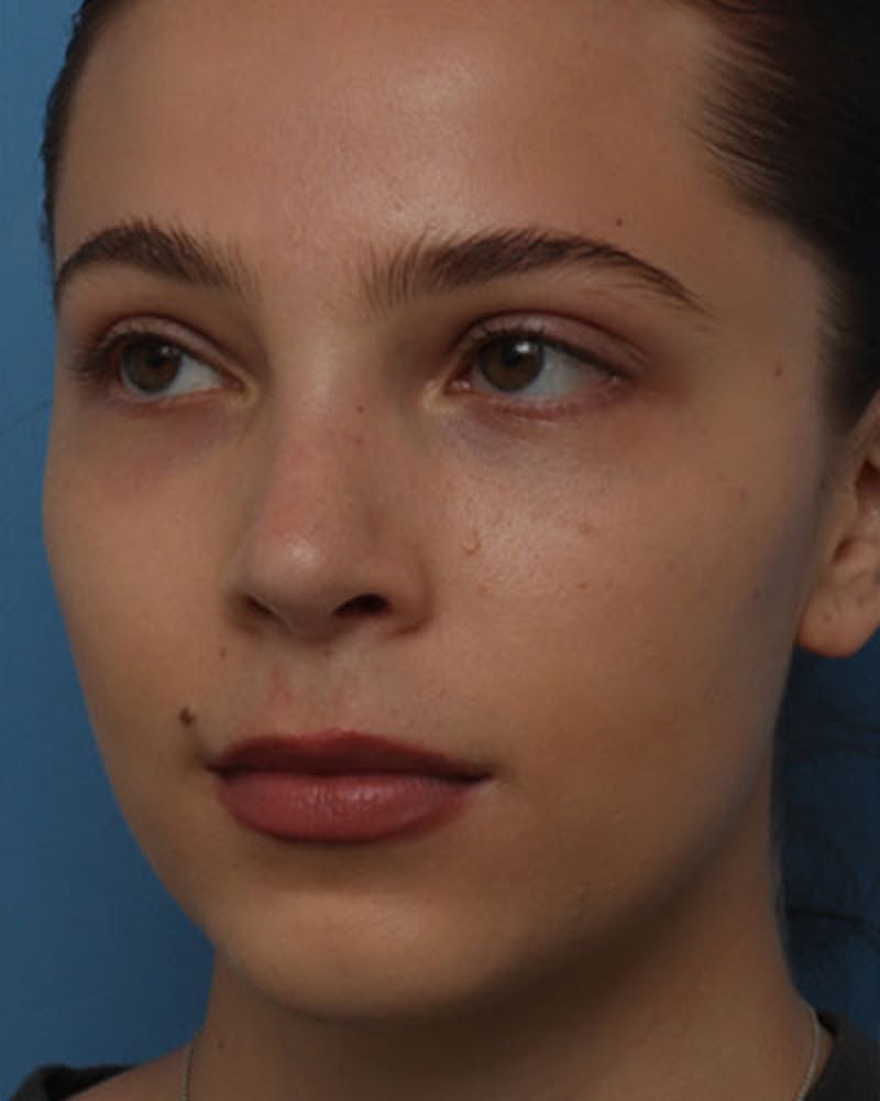 Rhinoplasty Before & After Gallery - Patient 258728 - Image 4
