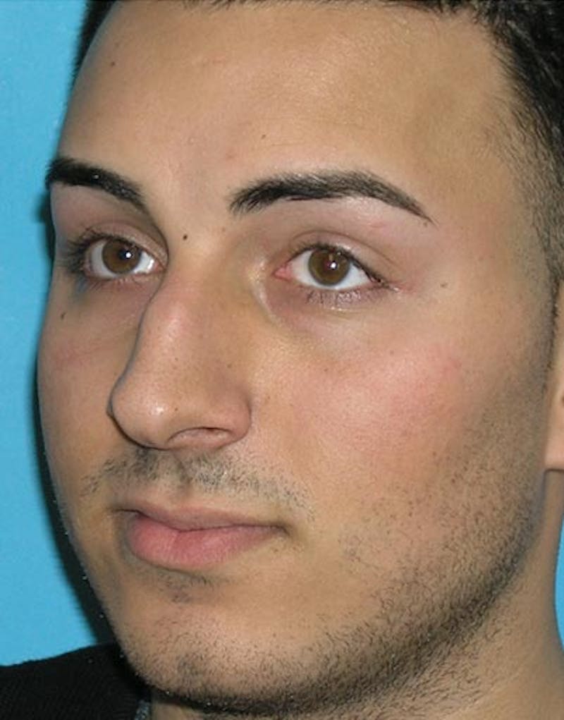Favorite Male Rhinoplasty Before & After Gallery - Patient 338840 - Image 3
