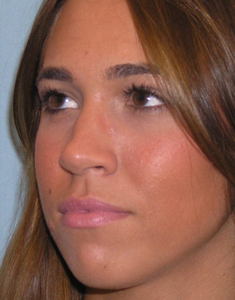 Foundation Rhinoplasty / Crooked Nose Before & After Gallery - Patient 278786 - Image 5