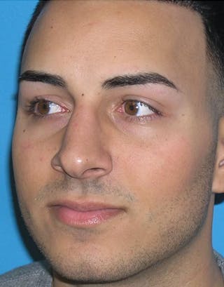 Favorite Male Rhinoplasty Before & After Gallery - Patient 338840 - Image 4