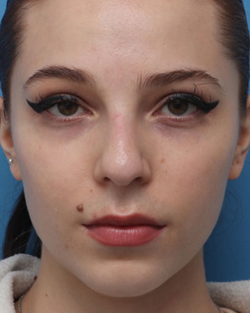 Rhinoplasty Before & After Gallery - Patient 258728 - Image 5