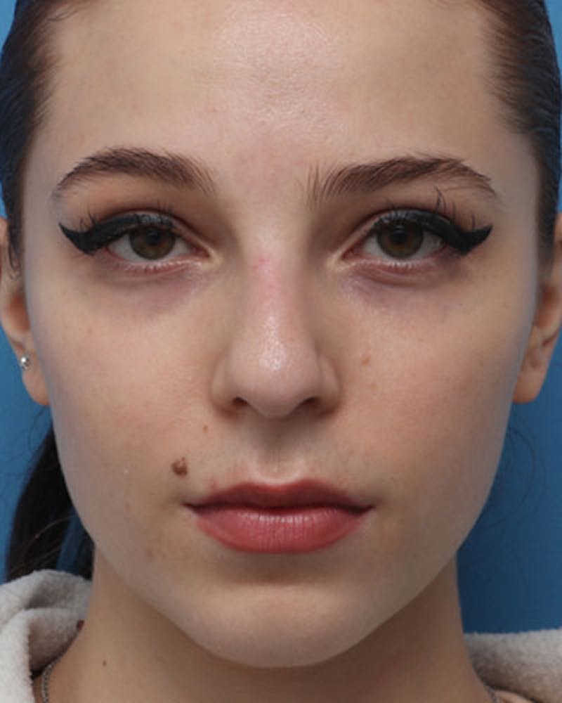 Favorite Rhinoplasty Before & After Gallery - Patient 219633 - Image 5