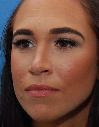 Favorite Foundation Rhinoplasty / Crooked Nose Before & After Gallery - Patient 173799 - Image 6