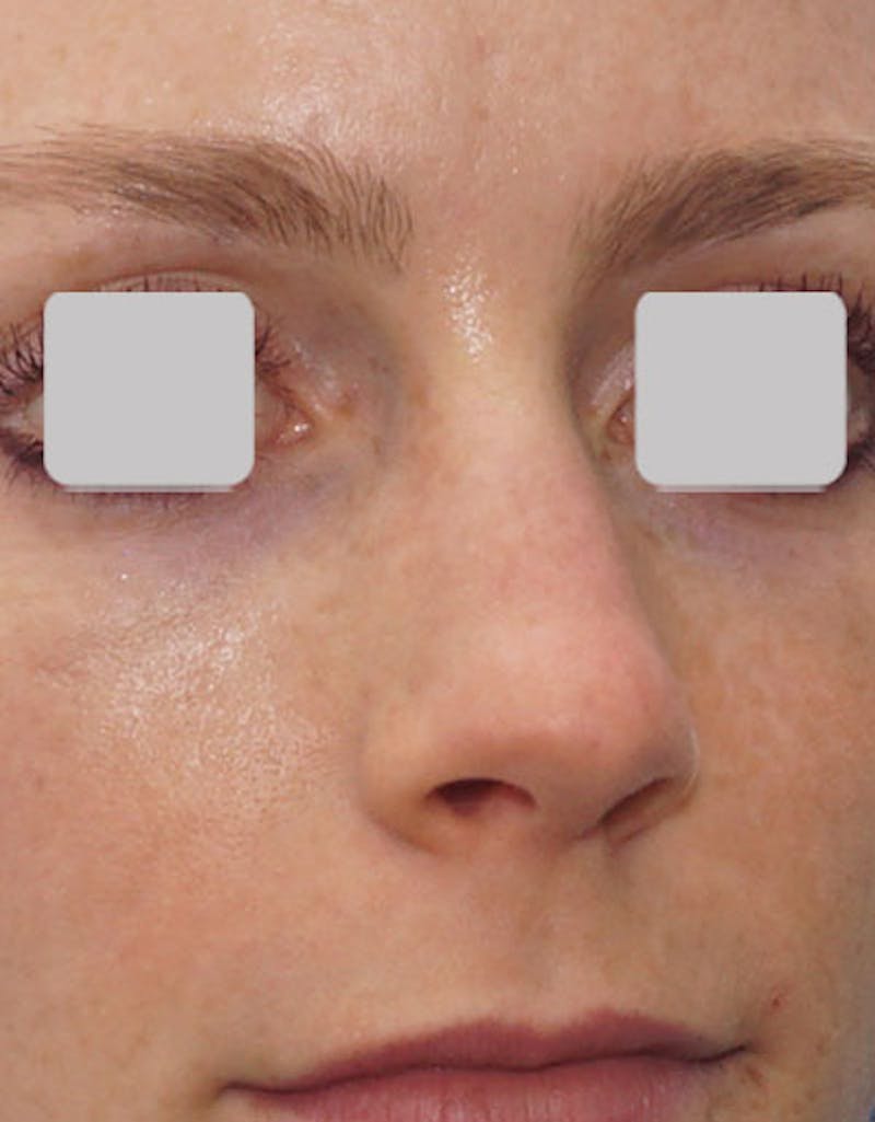 Favorite Revision Rhinoplasty Before & After Gallery - Patient 174327 - Image 3