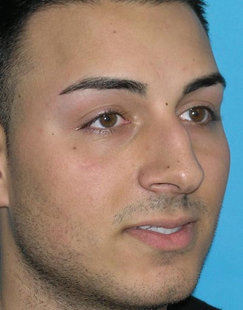 Favorite Male Rhinoplasty Before & After Gallery - Patient 338840 - Image 5