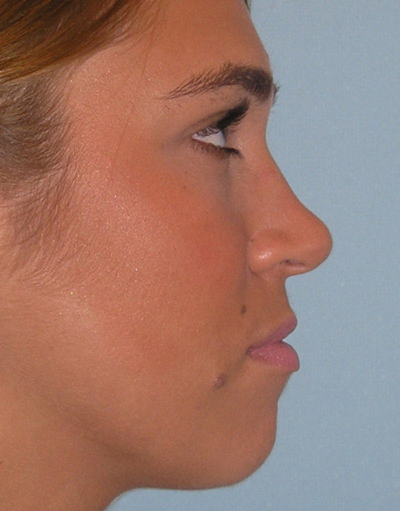 Foundation Rhinoplasty / Crooked Nose Before & After Gallery - Patient 278786 - Image 7