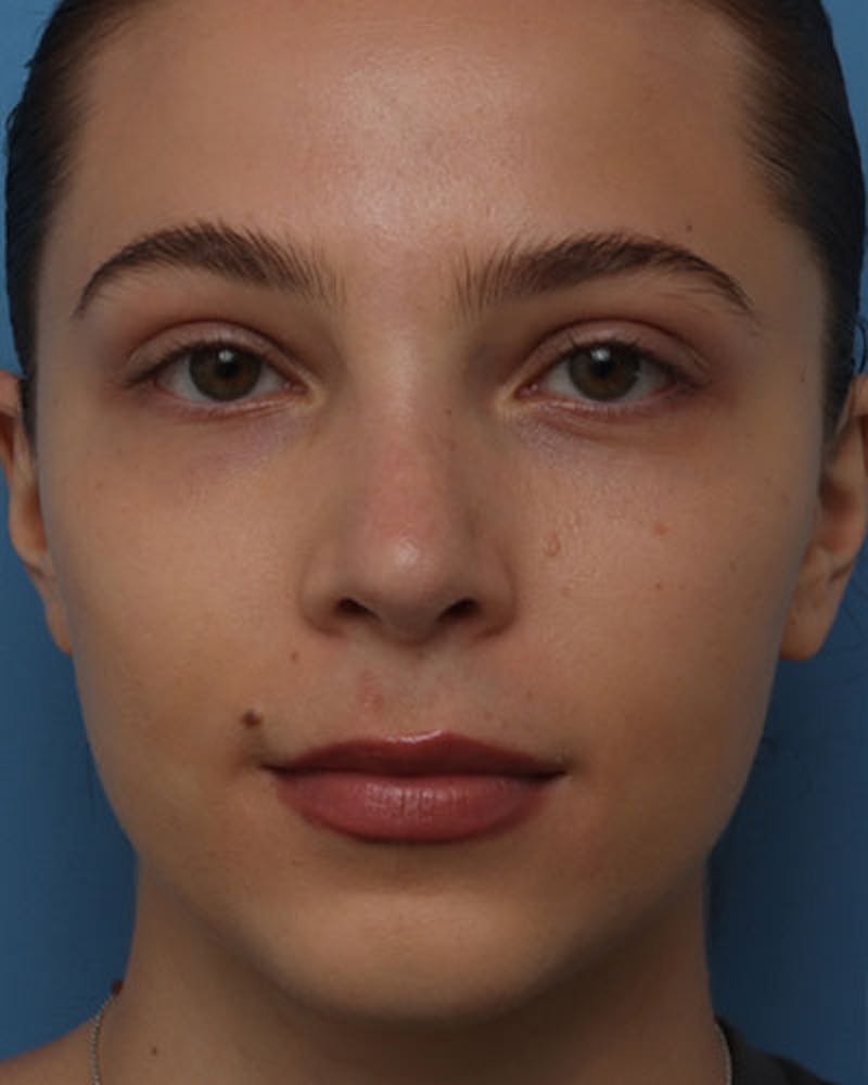 Rhinoplasty Before & After Gallery - Patient 258728 - Image 6
